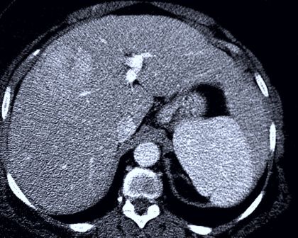 Liver HCC cross-sectional imaging